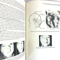 Vintage Reanimation of The Paralyzed Face Book Hardcover Leonard R. Rubin 1977