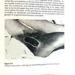 Pressure Ulcers Principles of Technique of Management Book Hardcover 1980