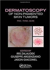 Dermatoscopy of Non-Pigmented Skin Tumors: Pink – Think – Blink [Hardcover] Z…